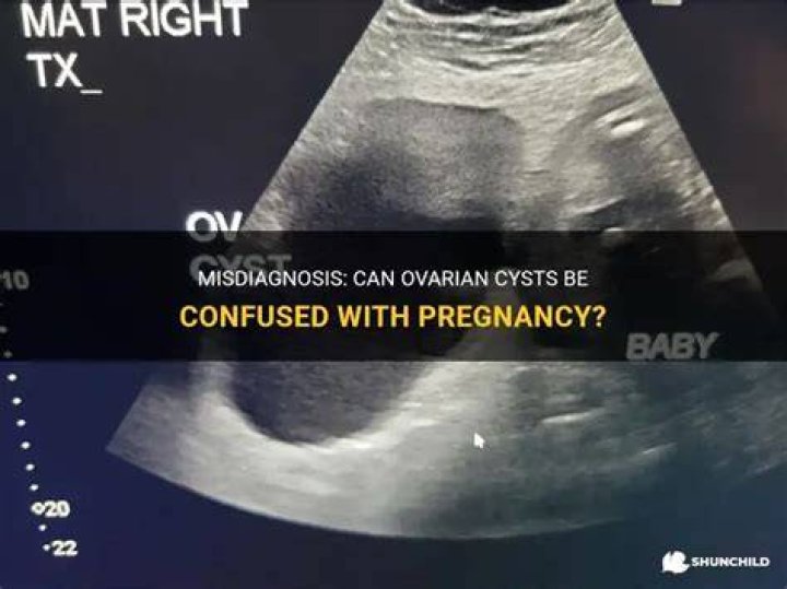 Can a cyst be confused with pregnancy?