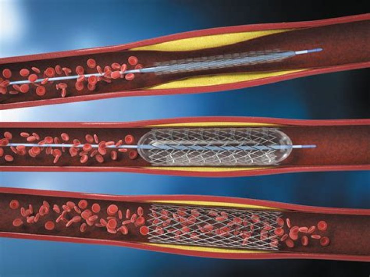 Can you put a stent in the Widowmaker?