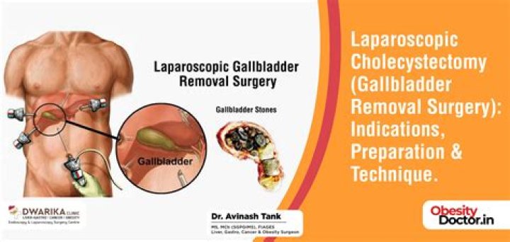 Is gallbladder removal a good idea?