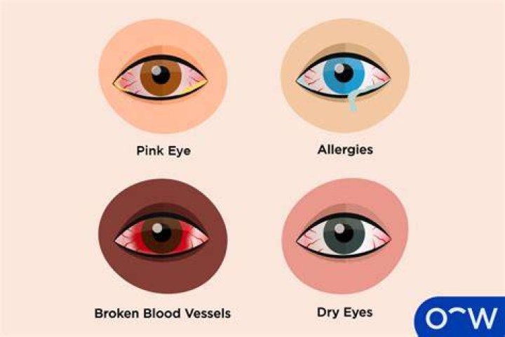 Why do eyes become red?